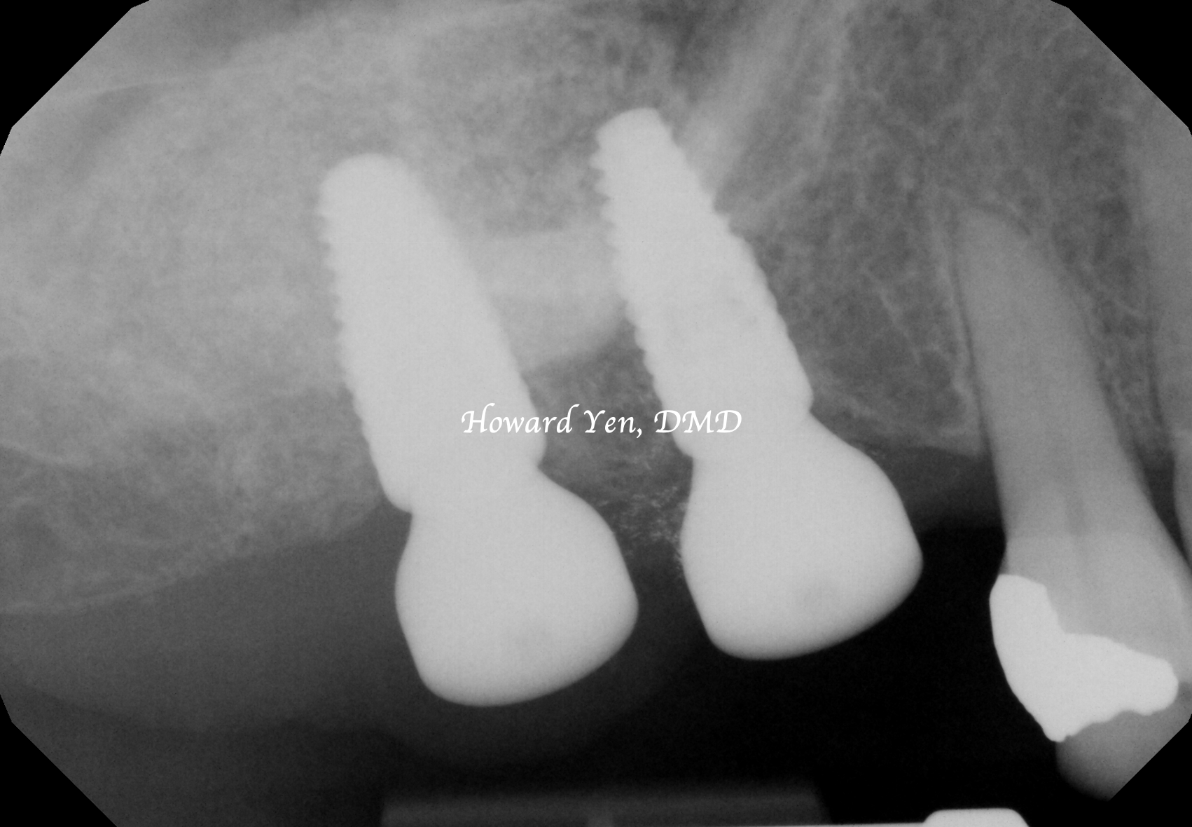 Sinus Lift + Implants Case 2 (Post-Op)