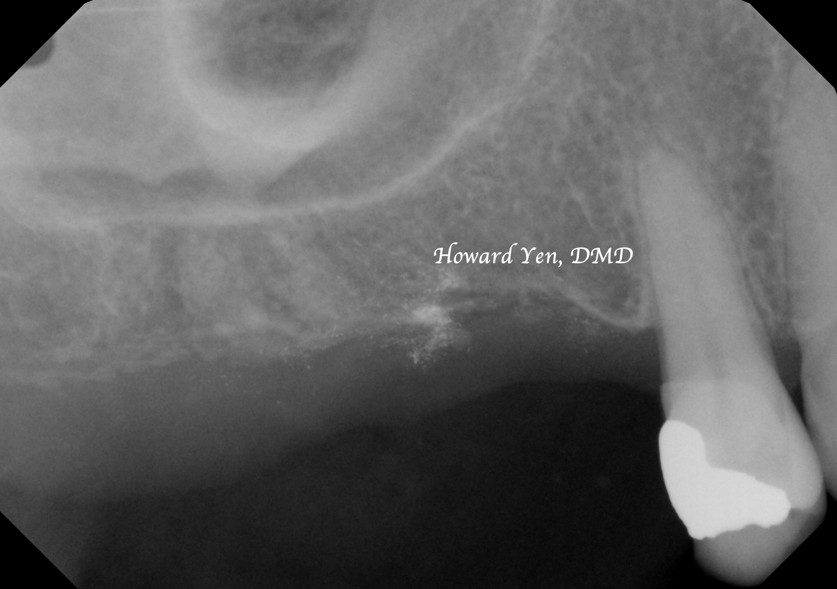 Sinus Lift + Implants Case 2 (Pre-Op)