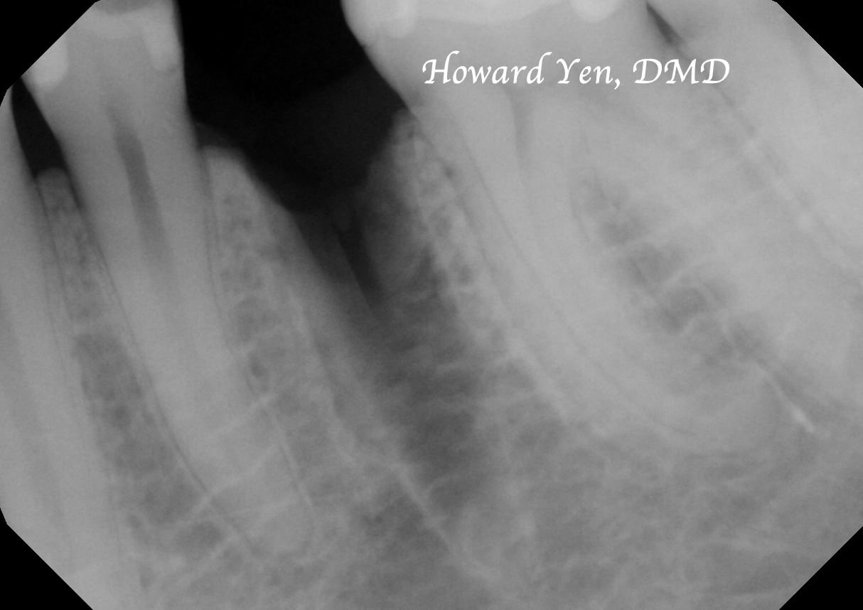 Bone Graft - Case 3 (Pre-Op)