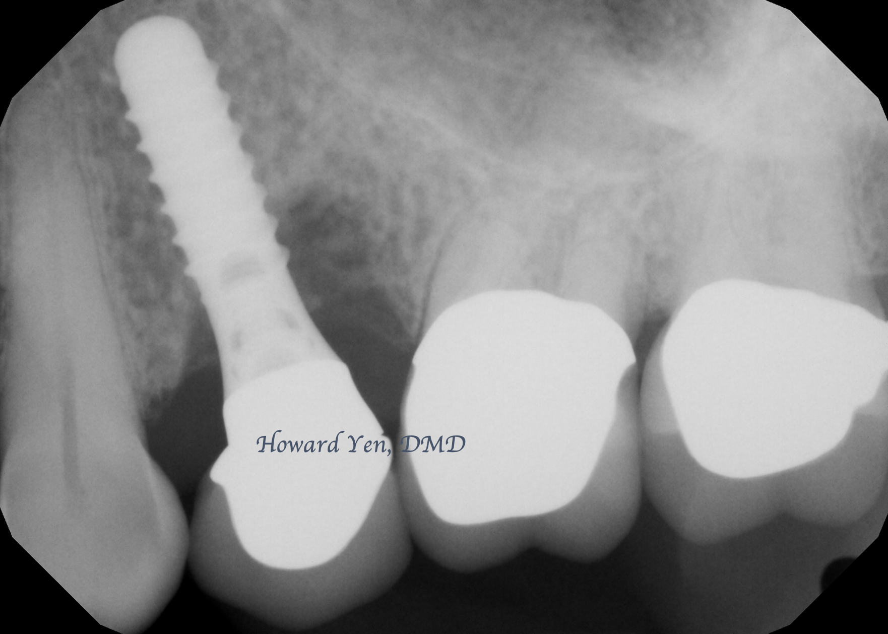 Peri-Implant Disease Case 3 (Pre-OP)