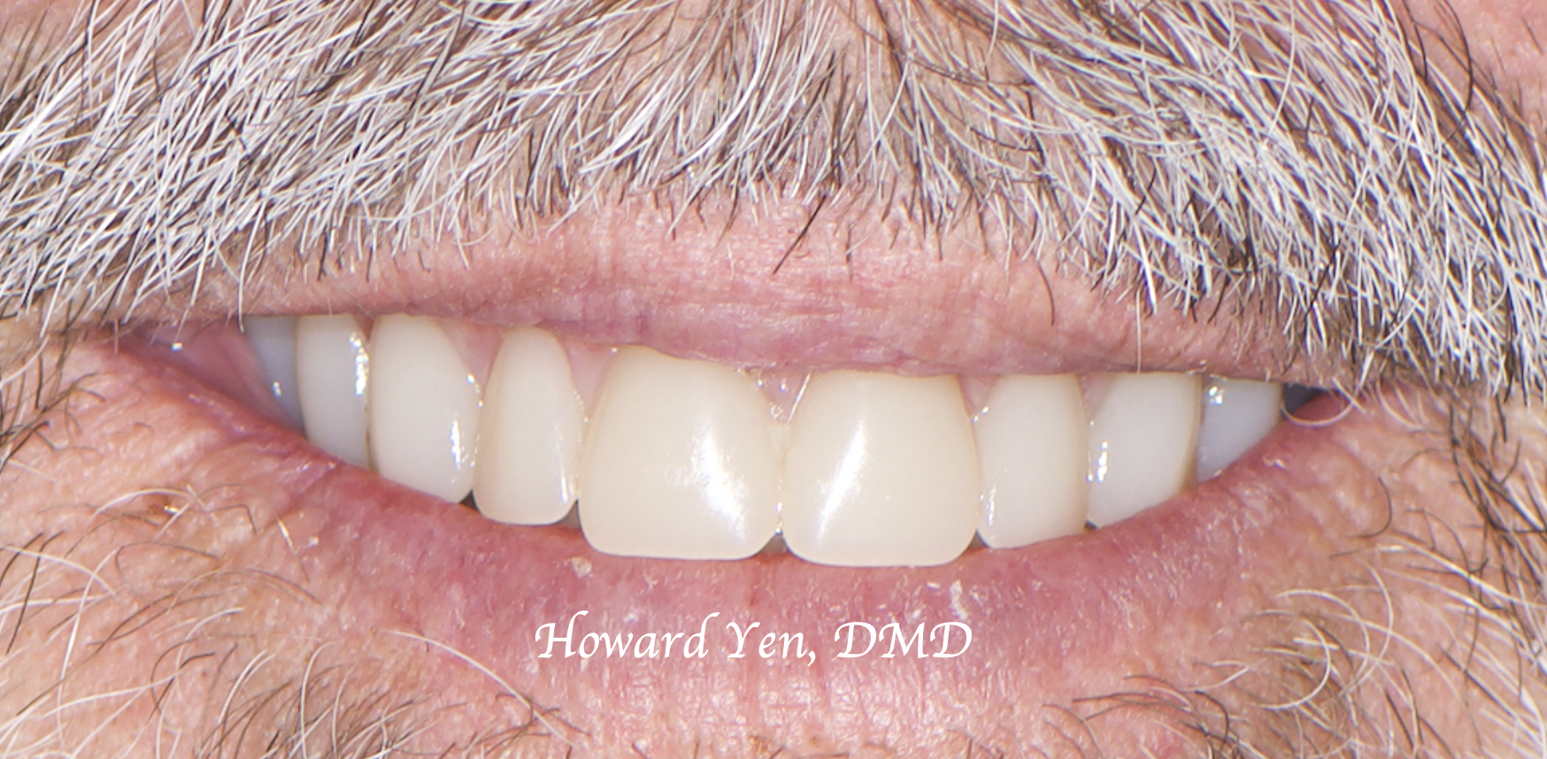 Fixed Hybrid Denture Implants-Case 1 (Post-Op)
