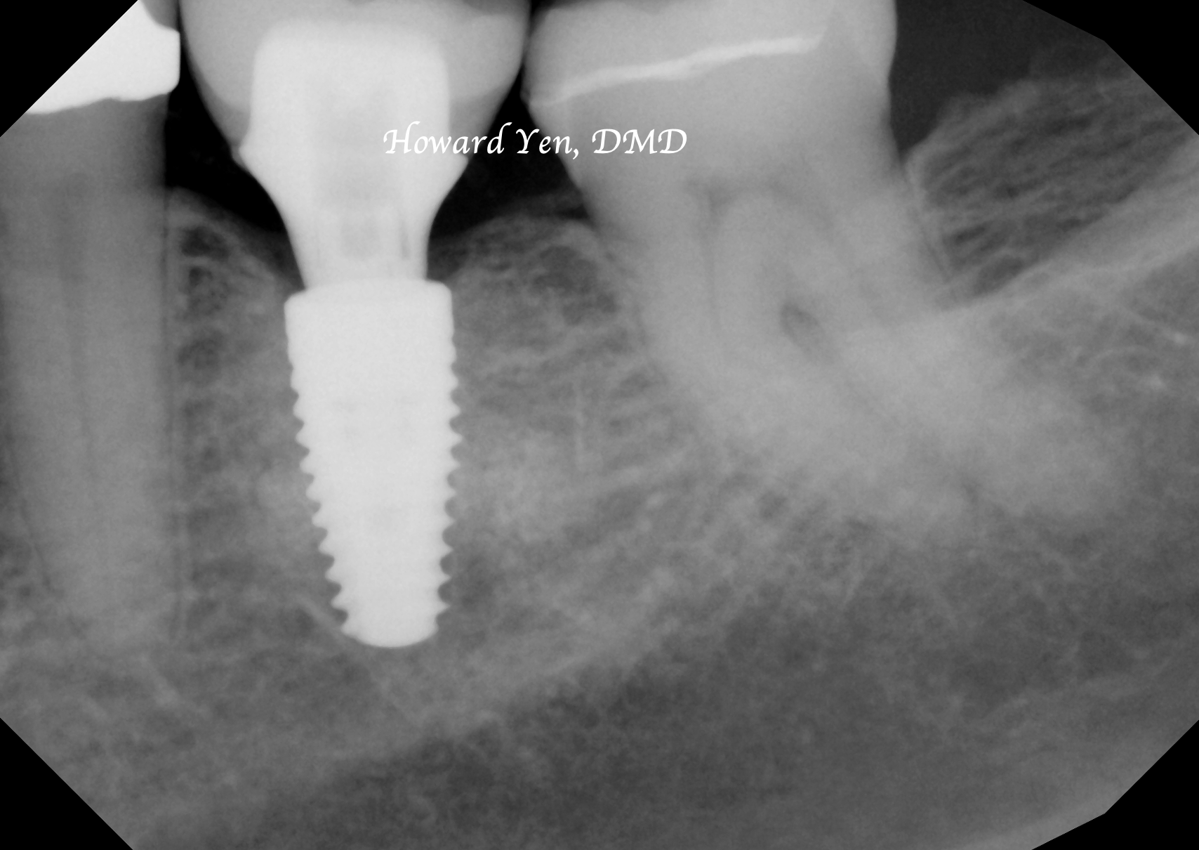Bone Graft - Case 2 (Implant Restored)