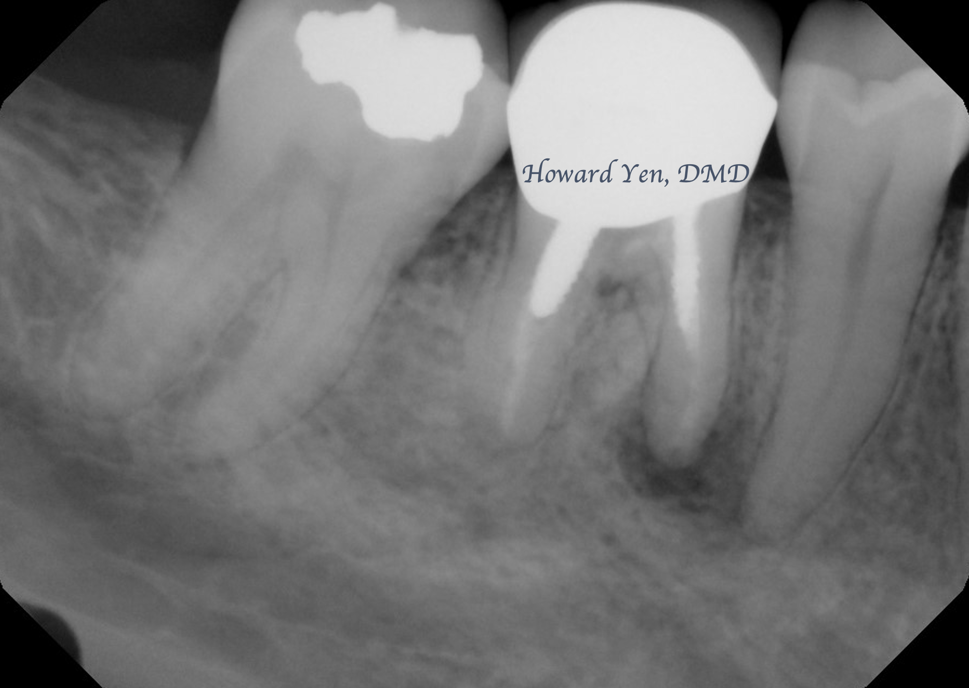 Root Amputation - Case 2 (Pre-Op)