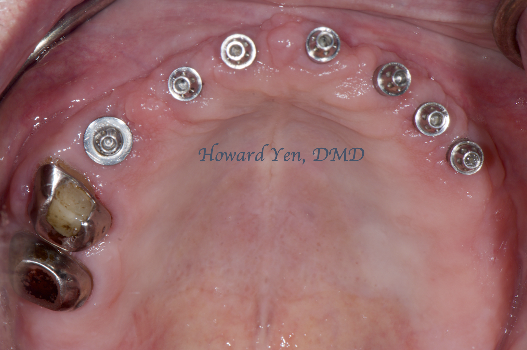Peri-Implant Disease Case 2 (Post-OP)