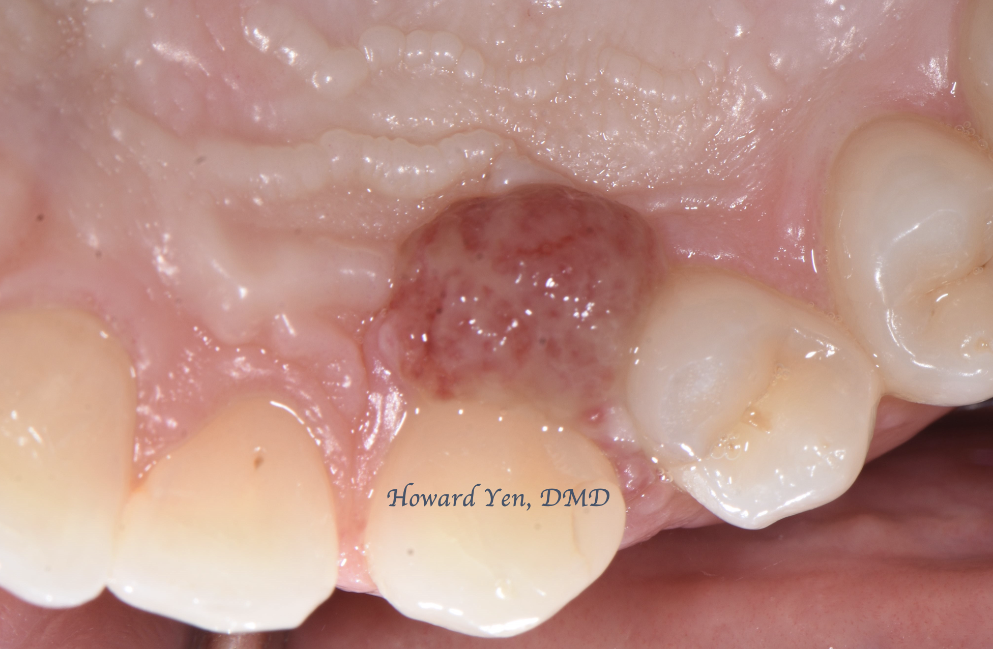 Biopsy - Case 1 (Pre-Op)