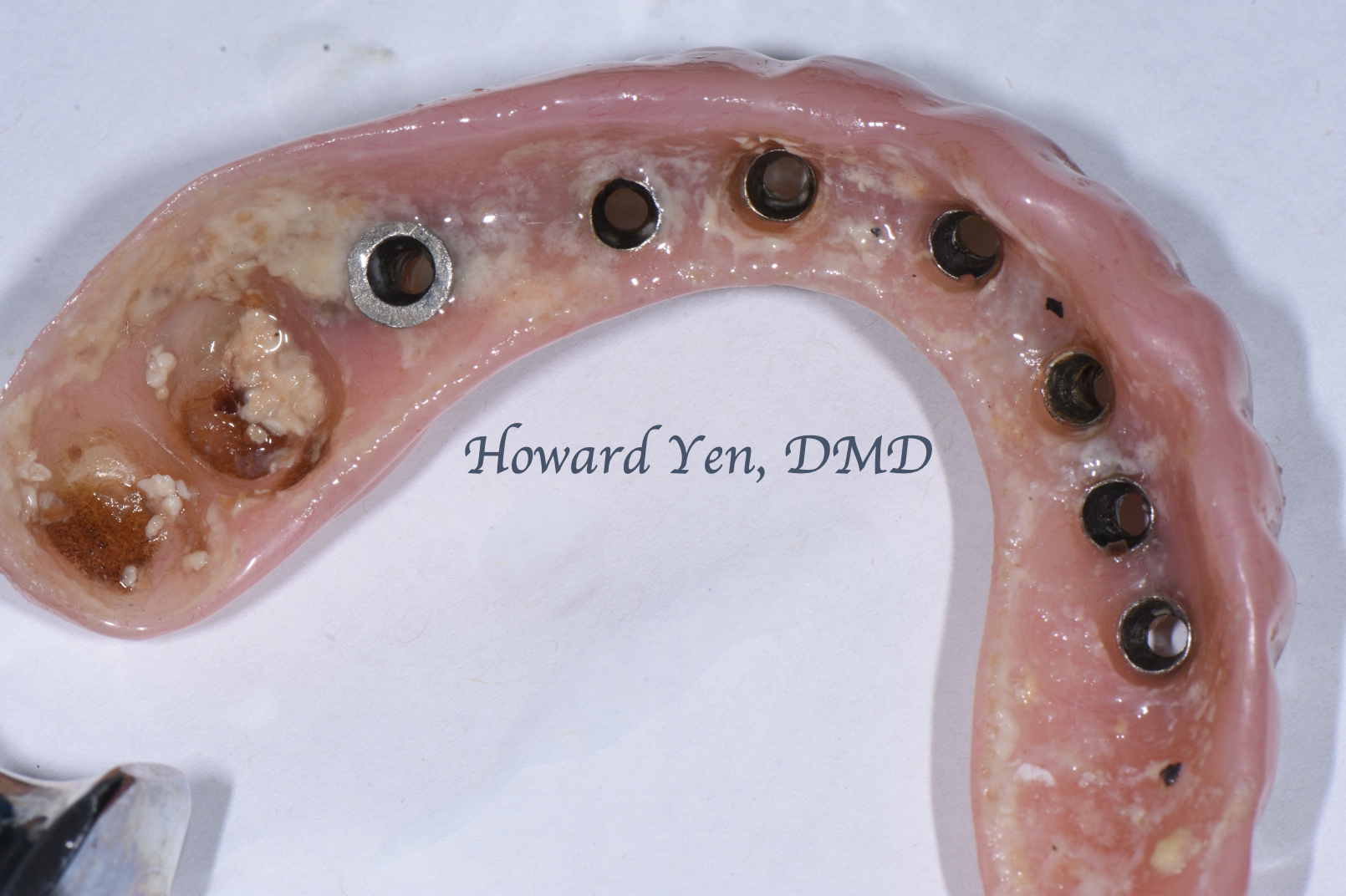 Peri-Implant Disease Case 2 (Pre-OP)