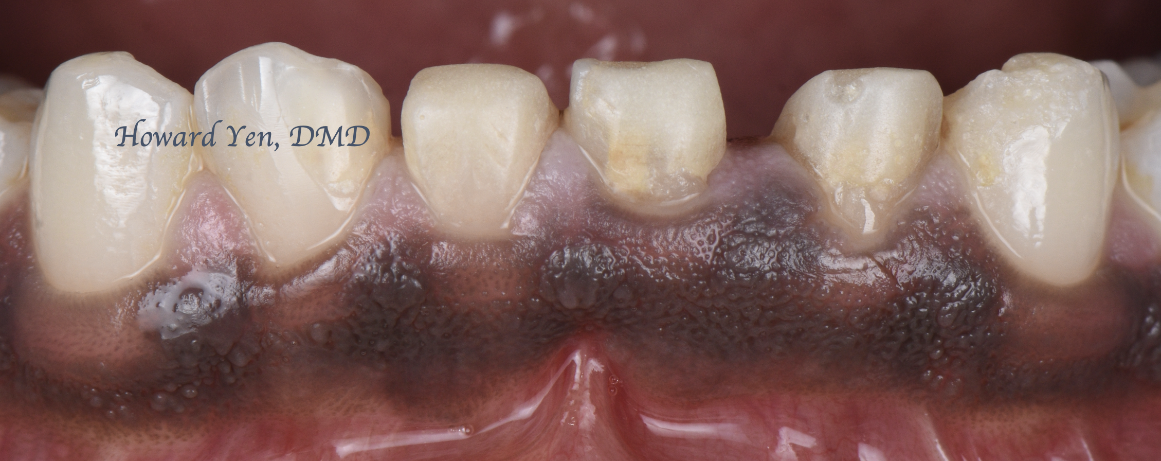 Crown Lengthening Case 2 (Pre-OP)