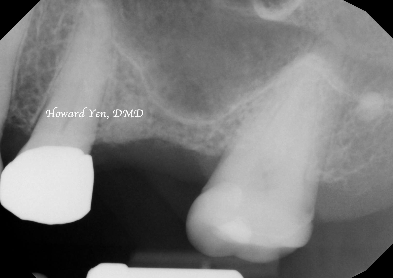 Sinus Lift Case 1 (Pre-Op)
