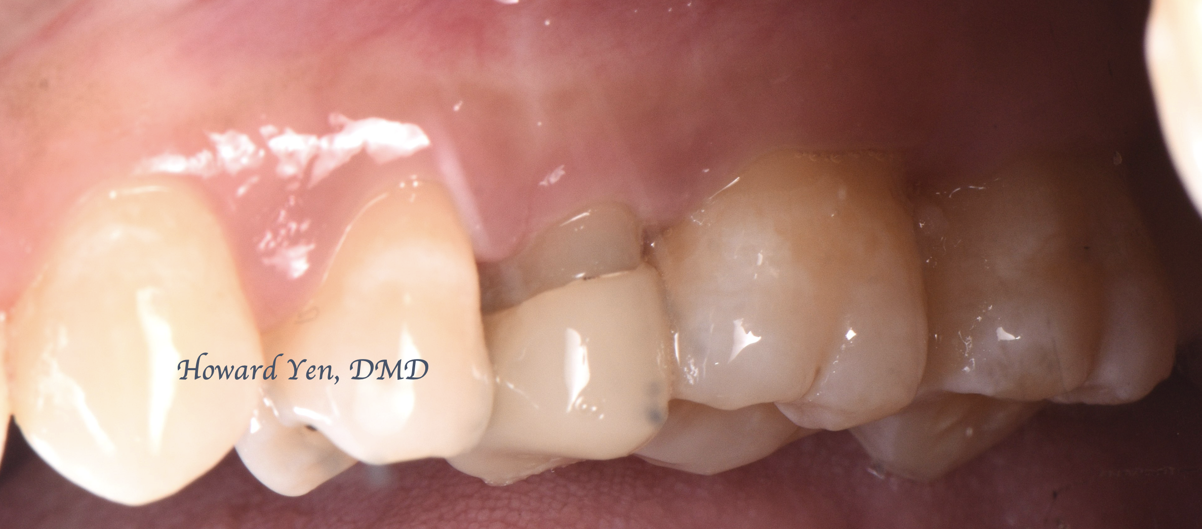 Crown Lengthening Case 1 (Post-OP)