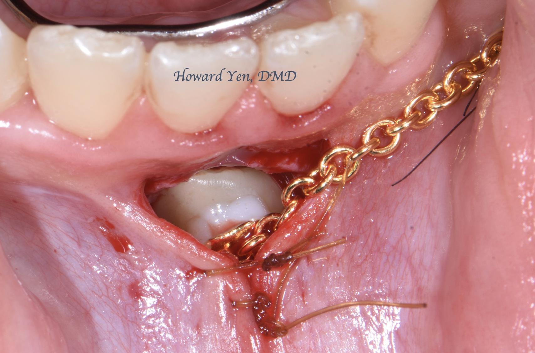 Tooth Exposure Case 2 (Post-Op)