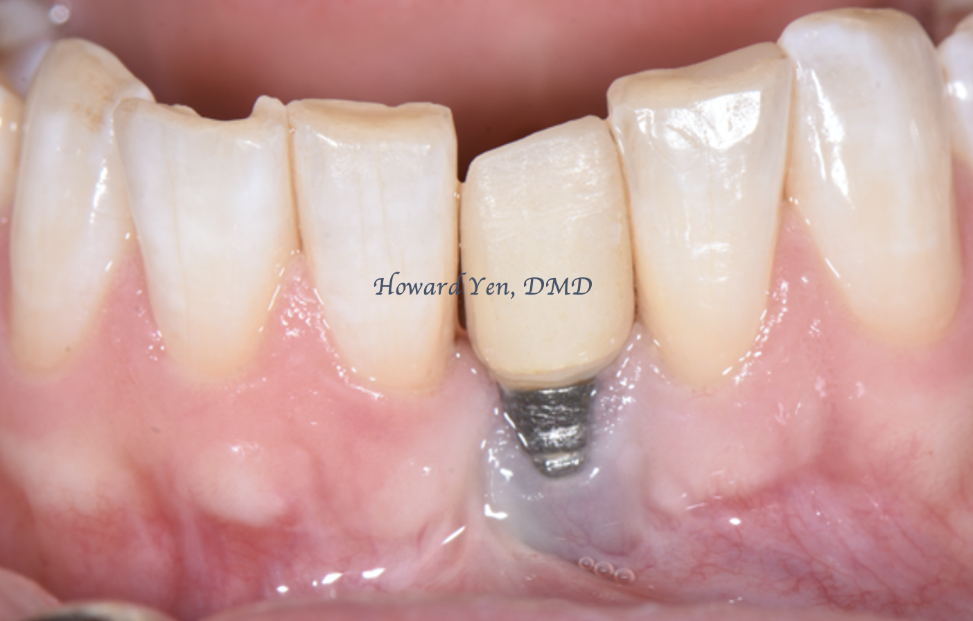 Peri-Implant Disease Case 1 (Pre-OP)