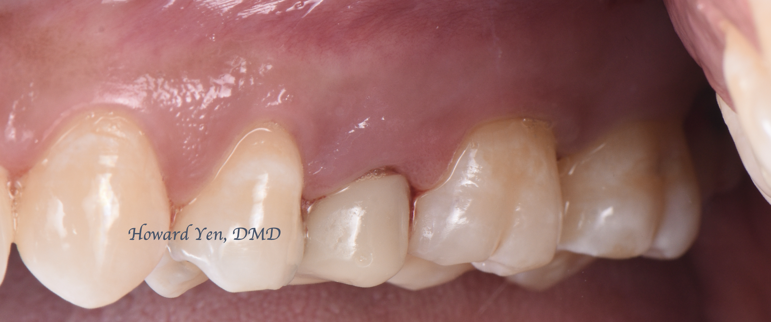 Crown Lengthening Case 1 (Pre-OP)