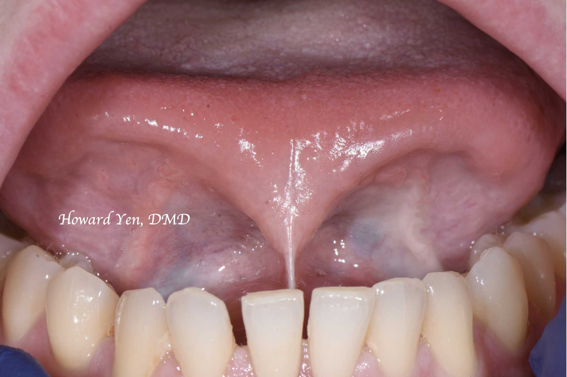 Frenectomy Case 4 (Pre-OP)