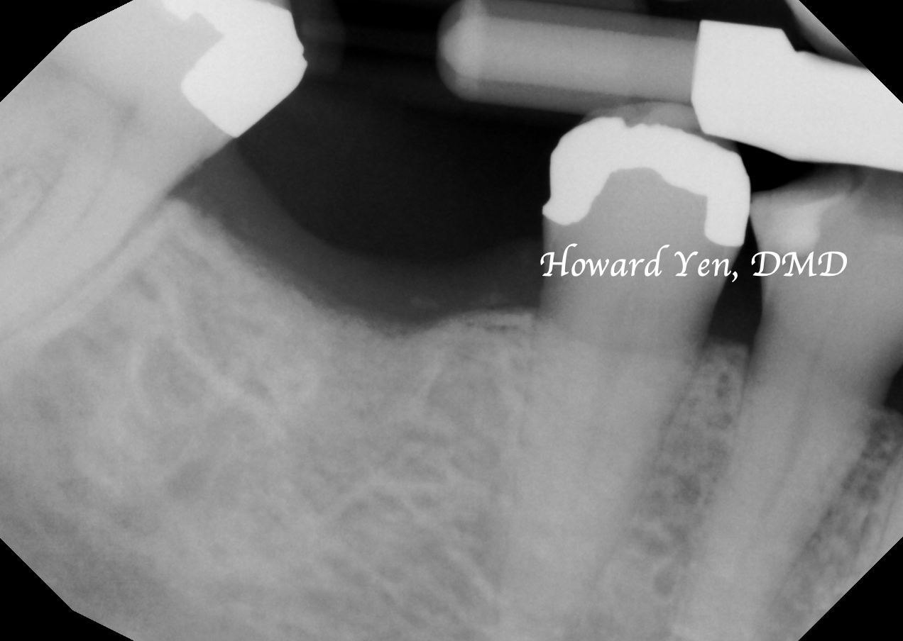 Bone Graft - Case 4 (Post-Op)