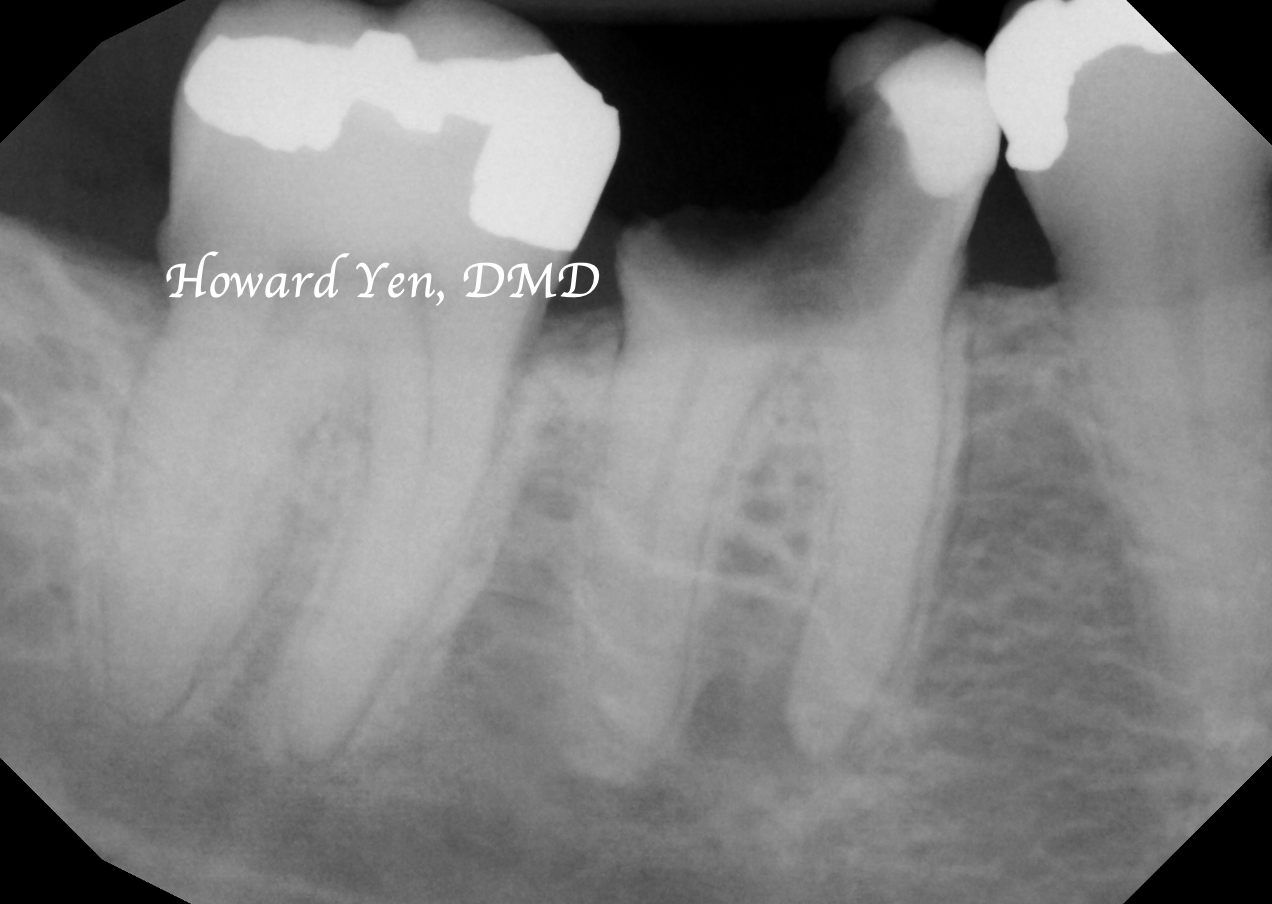 Bone Graft - Case 4 (Pre-Op)