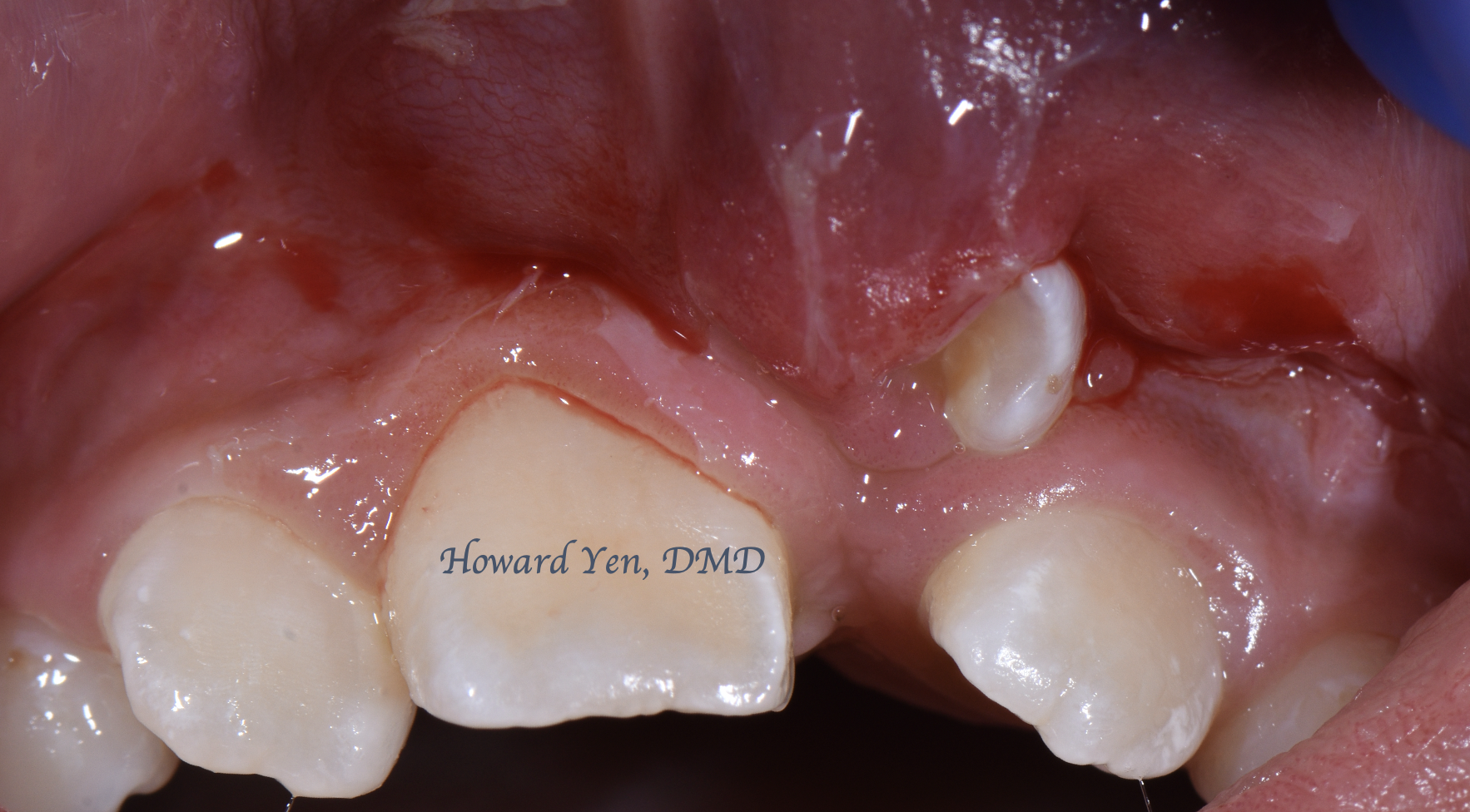 Tooth Exposure Case 1 (Pre-Op)