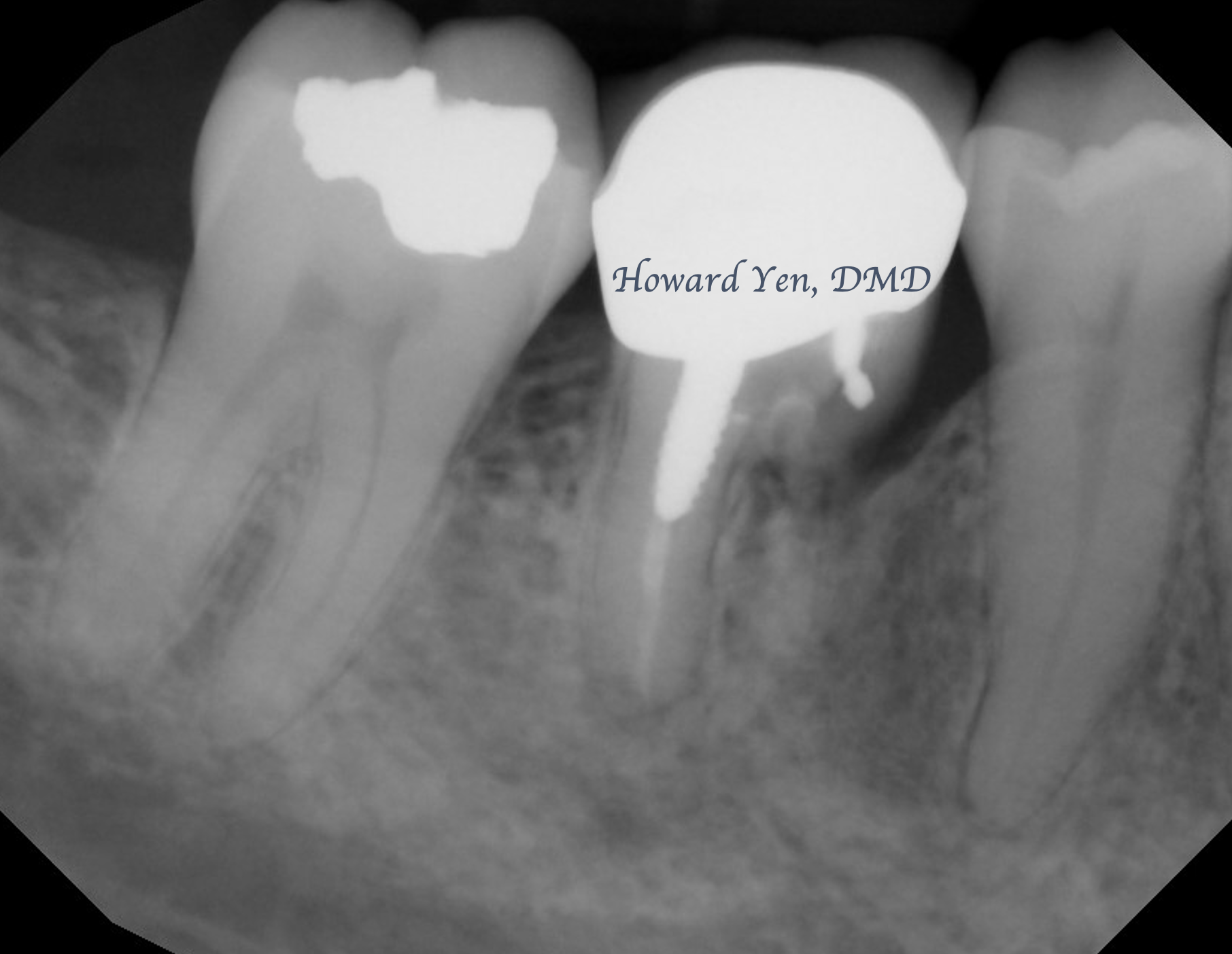 Root Amputation - Case 2 (Post-Op)