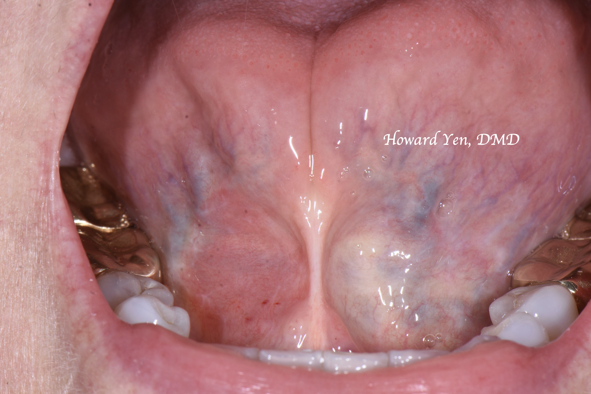 Frenectomy Case 3 (Pre-OP)