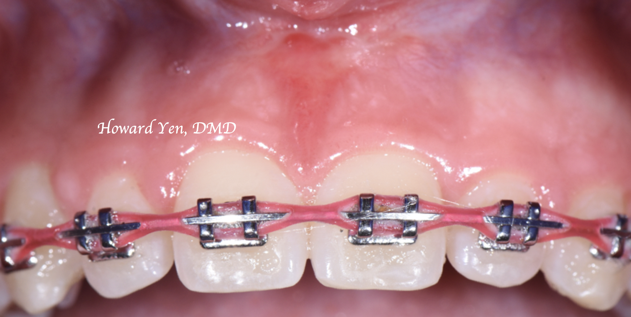 Frenectomy Case 1 (Post-OP)