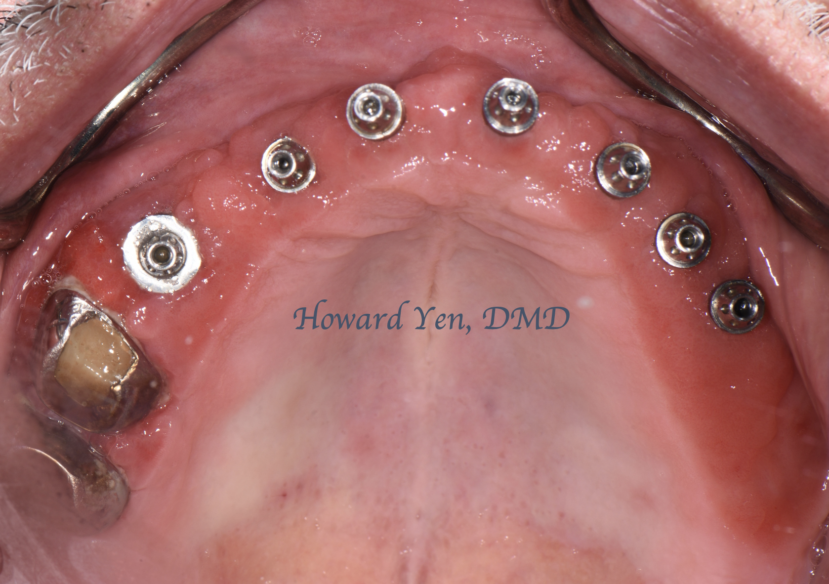 Peri-Implant Disease Case 2 (Pre-OP)