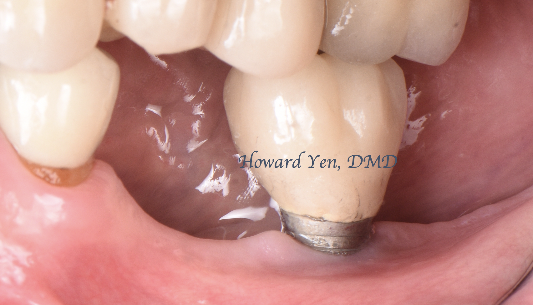 Peri-Implant Disease Case 4 (Post-OP)