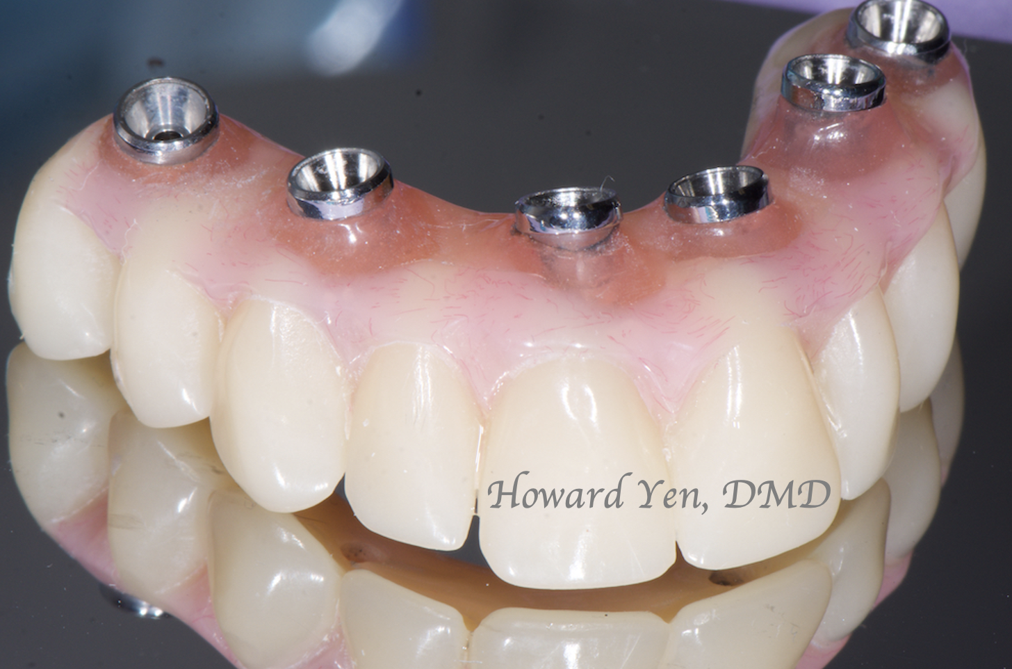 Fixed Hybrid Denture Implants-Case 1 (Temporary Prosthesis)