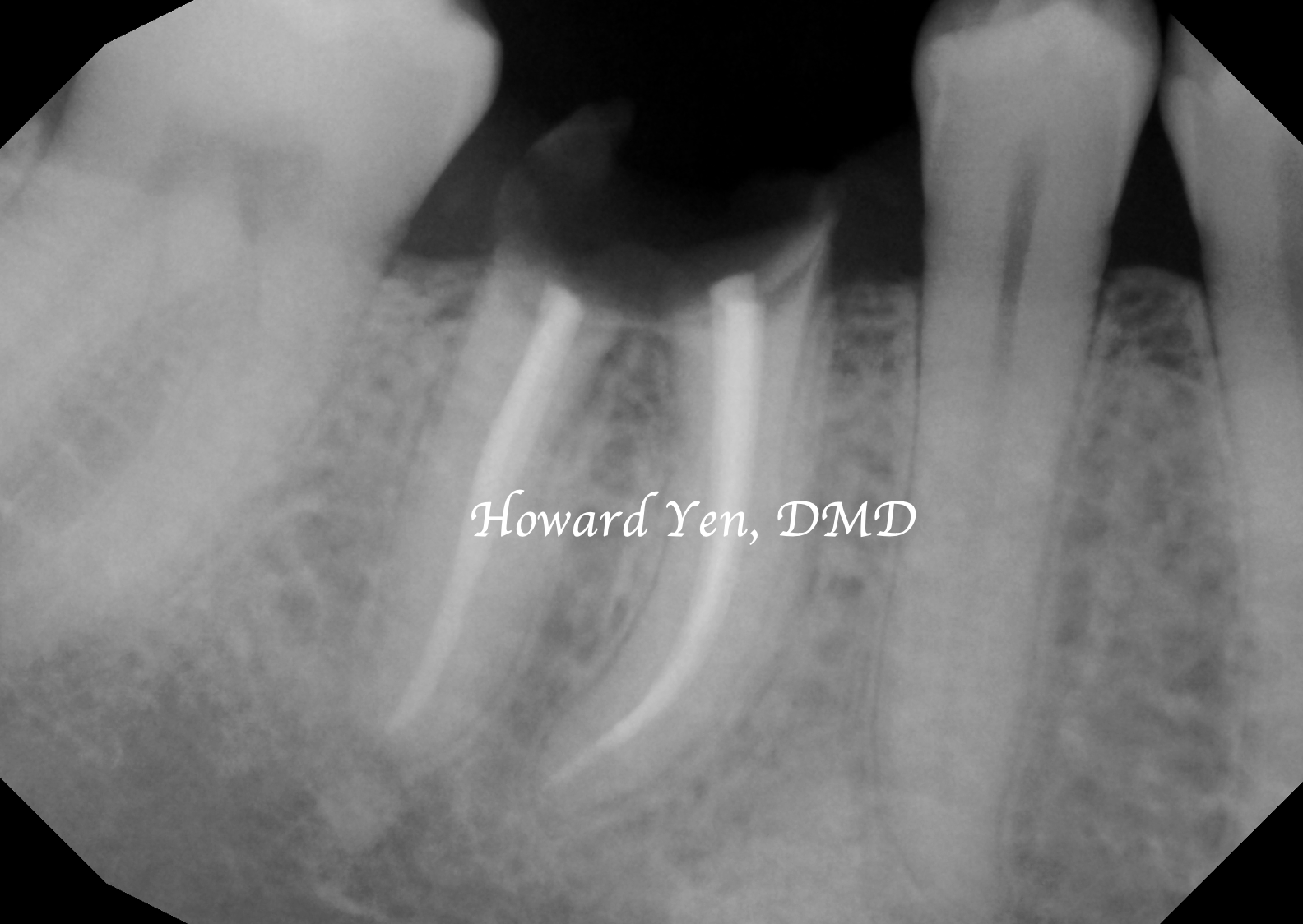Bone Graft - Case 1 (Pre-Op)