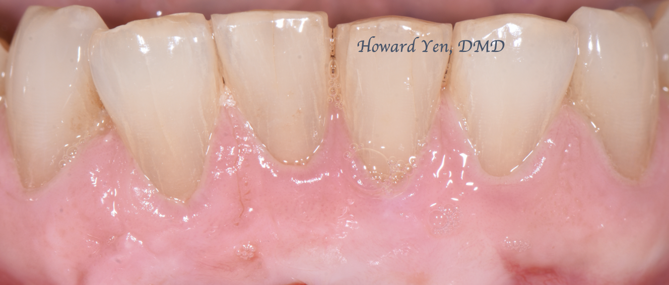 Receding Gum Case 2 (Post-OP)