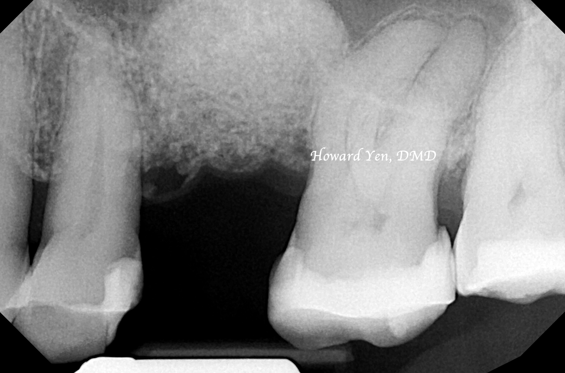 Sinus Lift Case 2 (Post-Op)