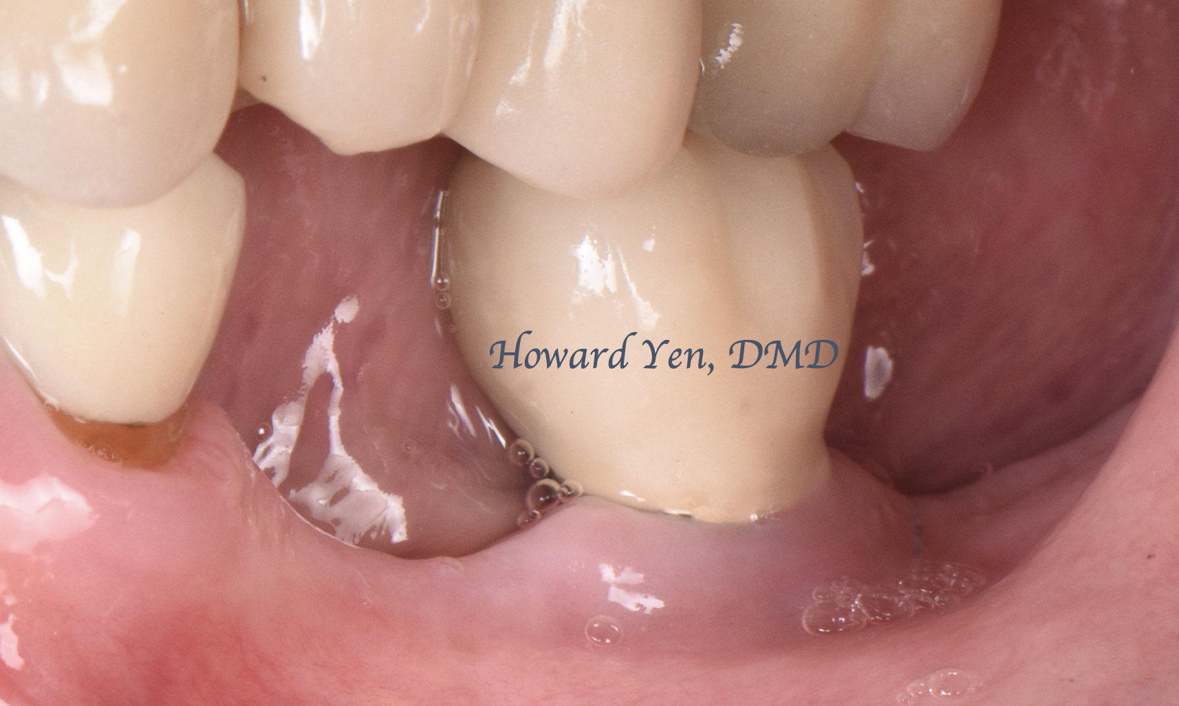 Peri-Implant Disease Case 4 (Pre-OP)