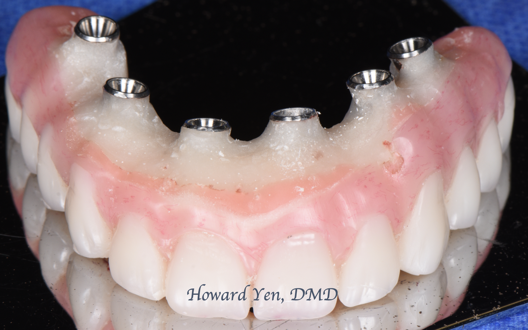 Fixed Hybrid Denture Implants Case 2 (Temporary Prosthesis)