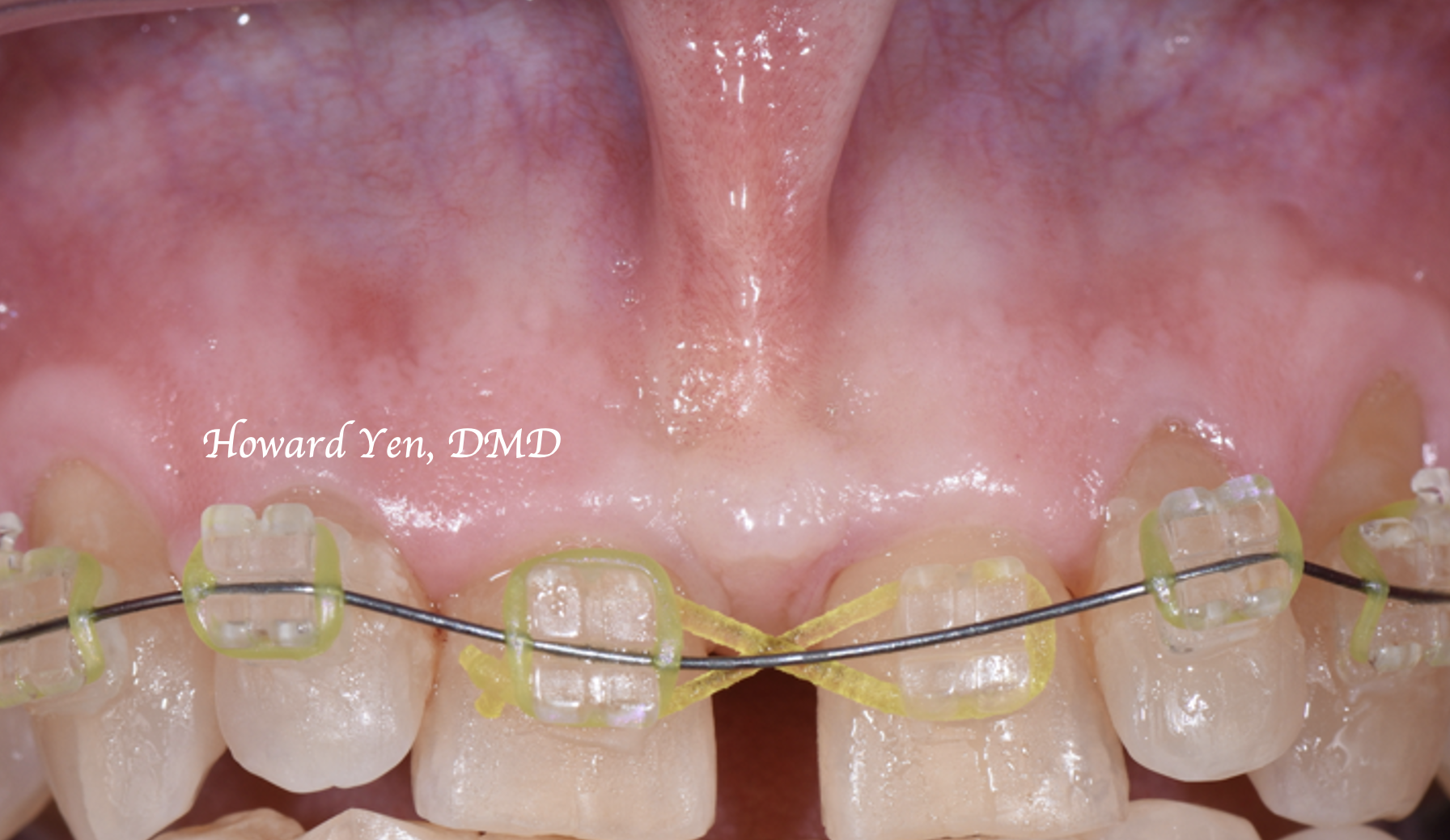 Frenectomy Case 2 (Pre-OP)
