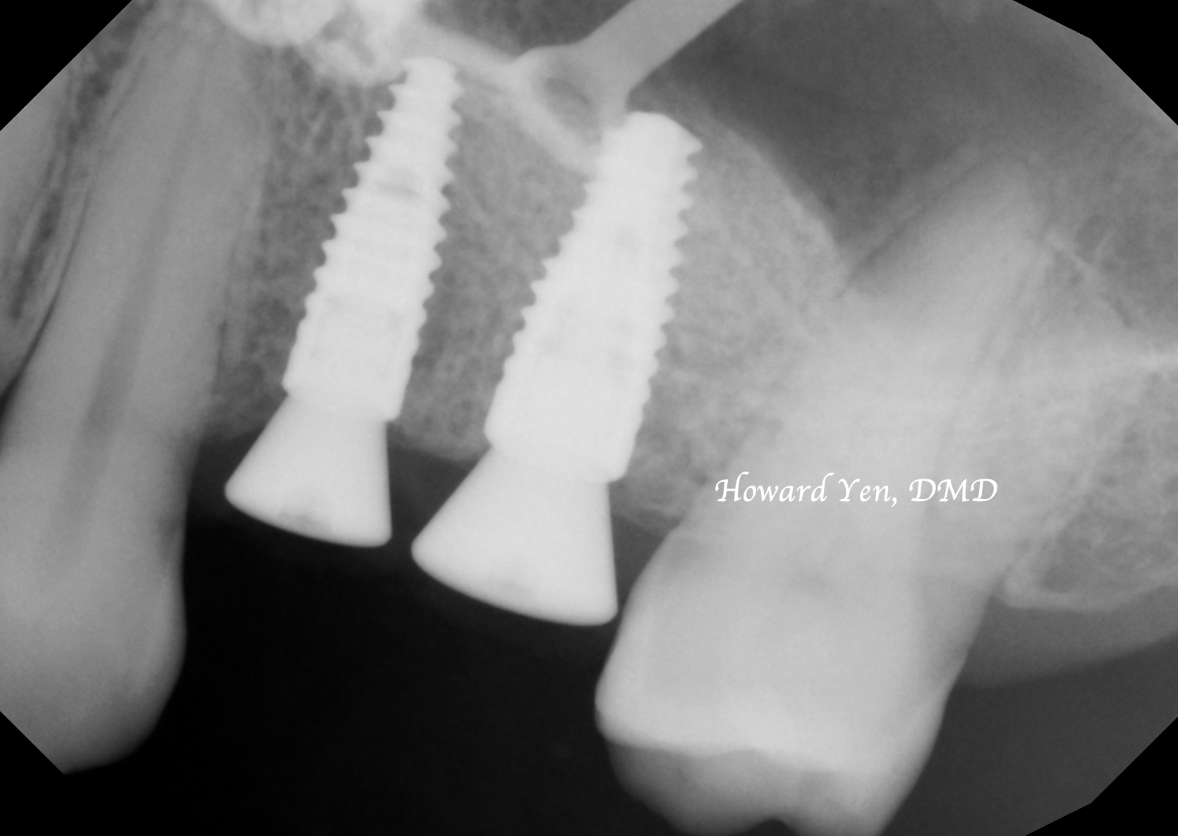 Sinus Lift + Implants Case 1 (Post-Op)