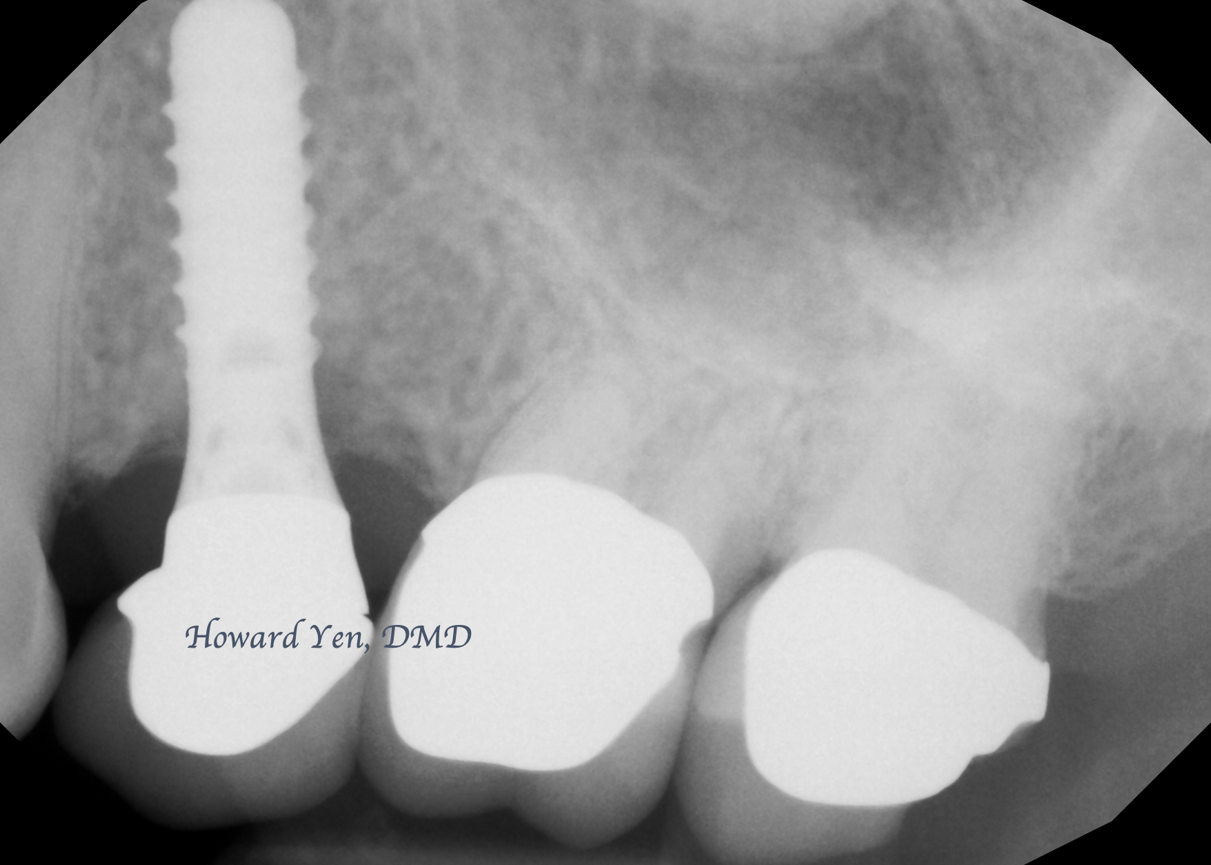Peri-Implant Disease Case 3 (Post-OP)