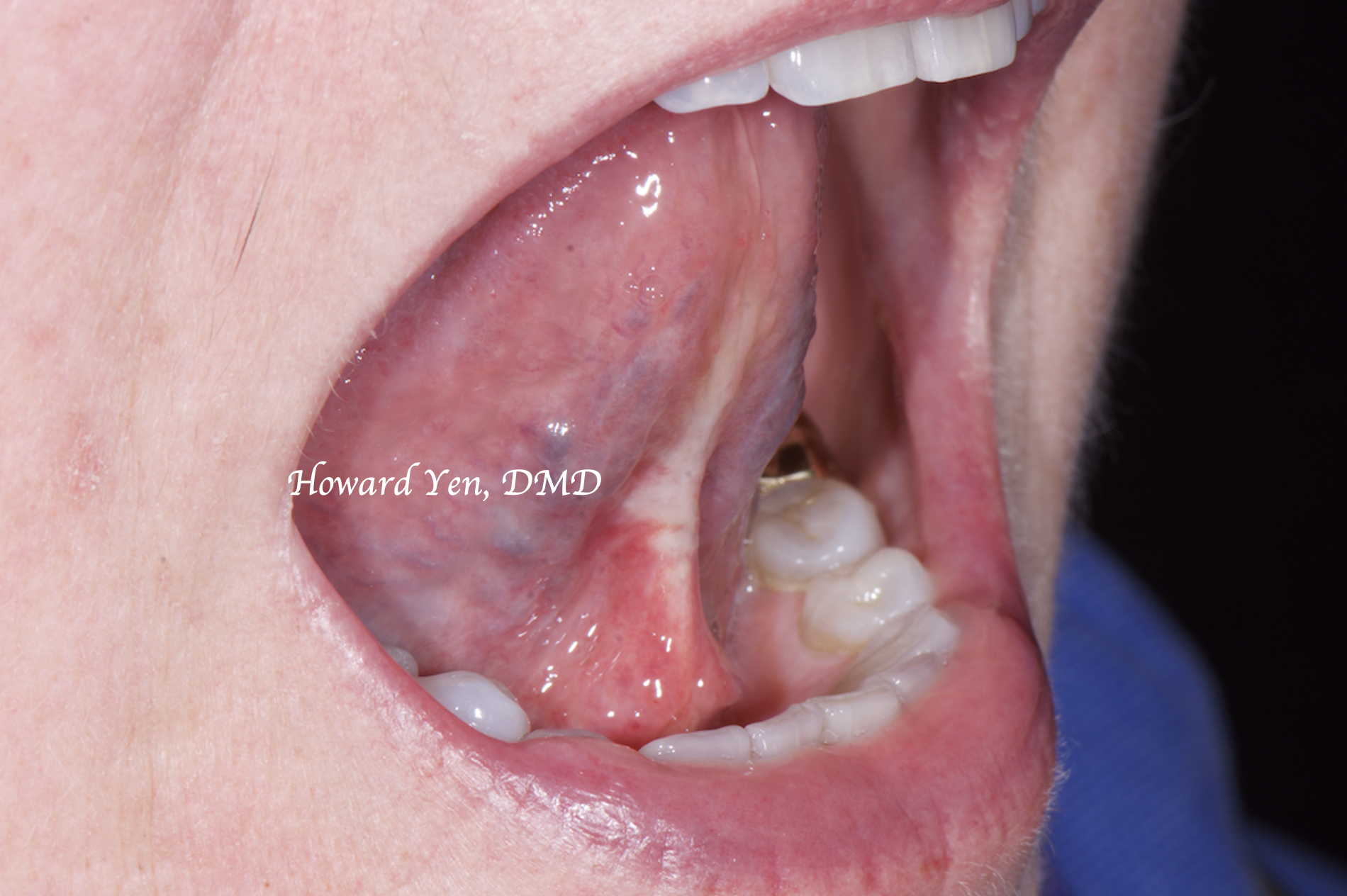 Frenectomy Case 3 (Post-OP)