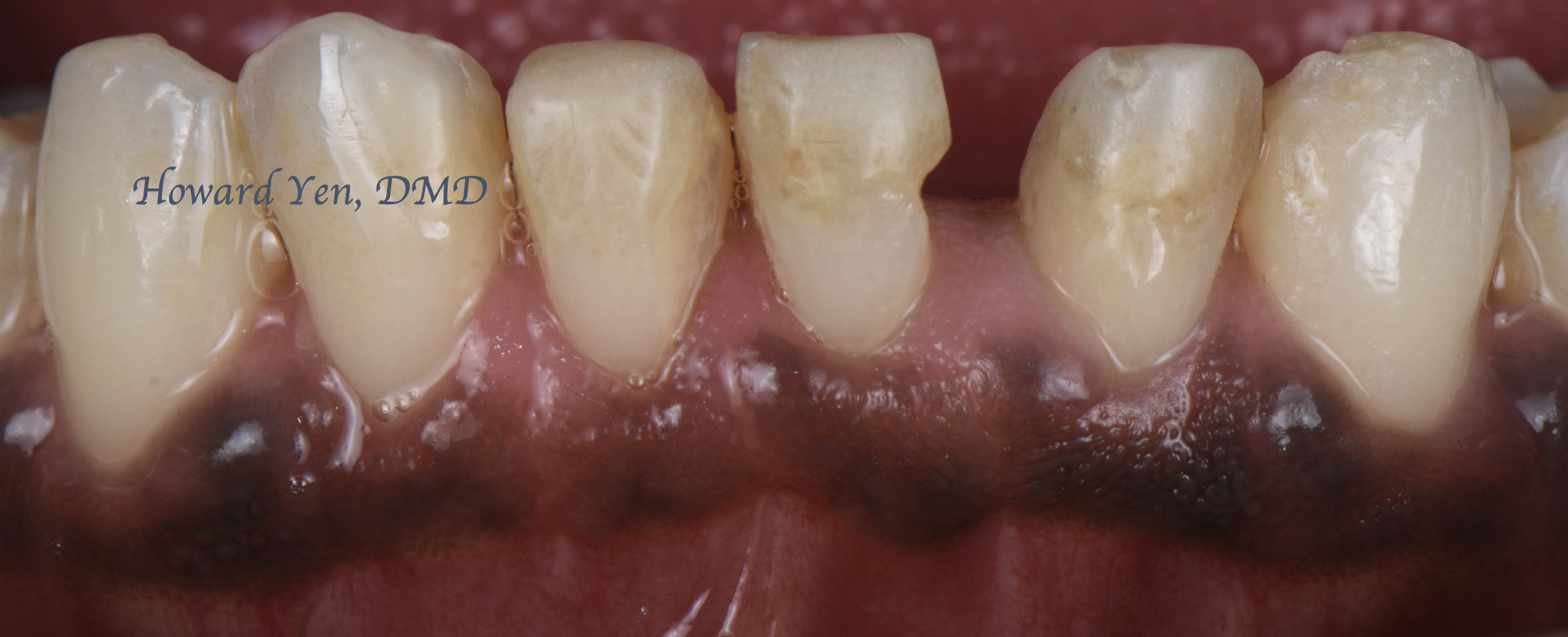 Crown Lengthening Case 2 (Post-OP)