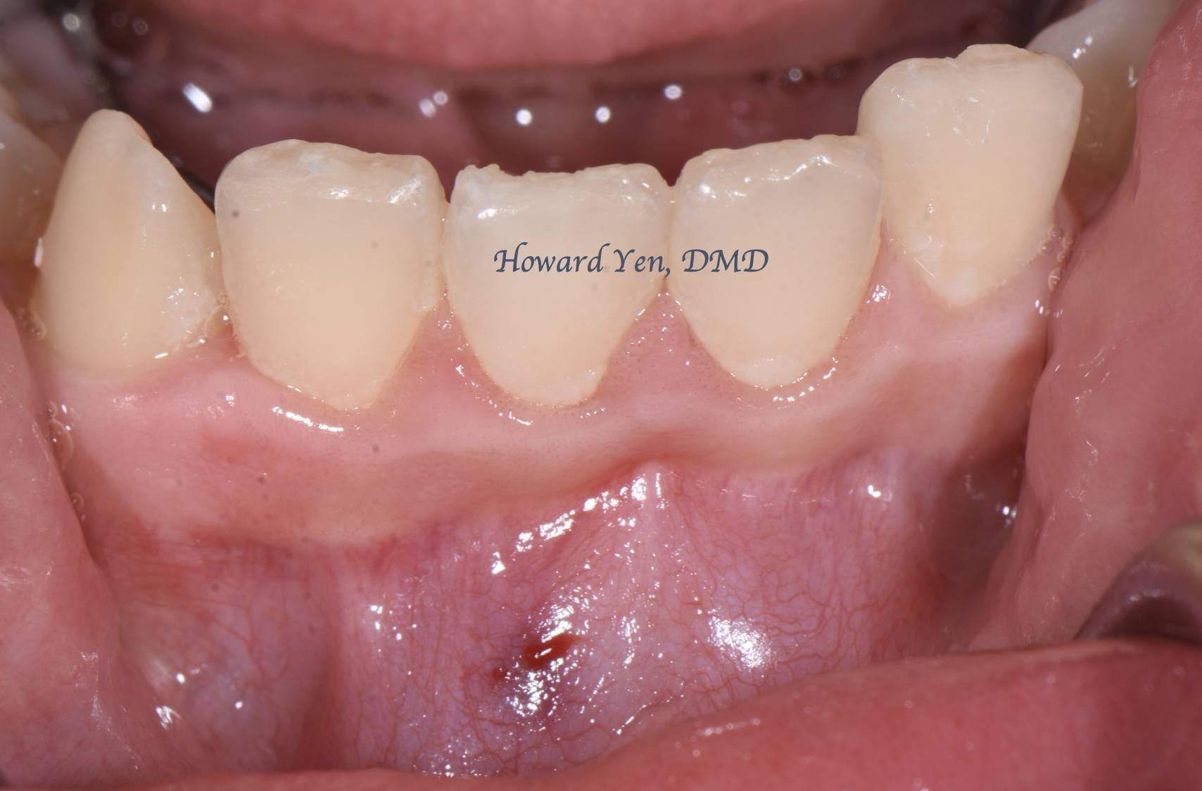 Tooth Exposure Case 2 (Pre-Op)