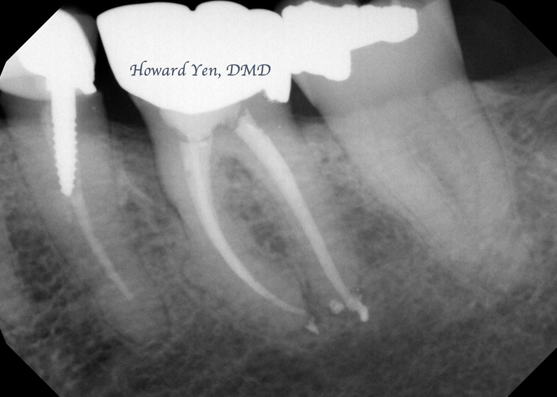 Root Amputation - Case 1 (Pre-Op)