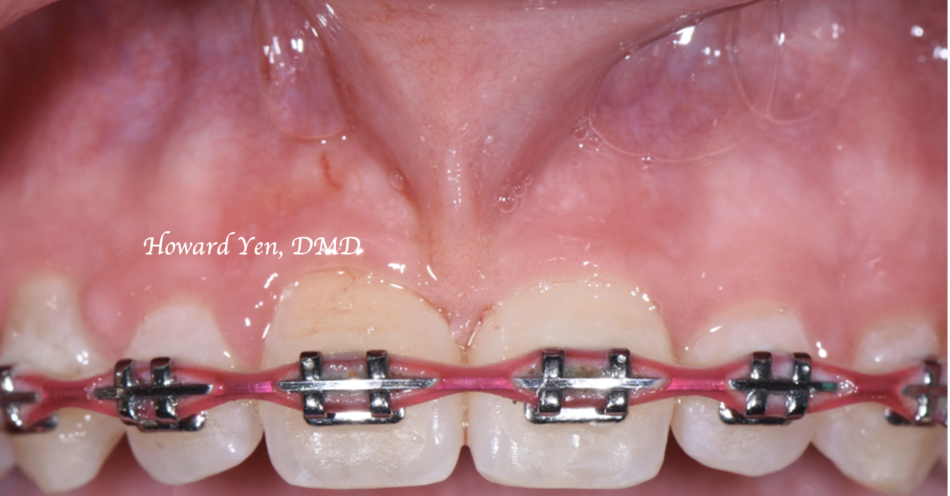 Frenectomy Case 1 (Pre-OP)