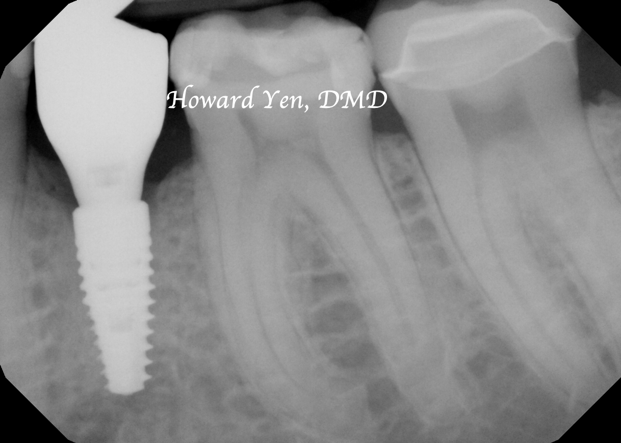 Bone Graft - Case 3 (Implant Restored)