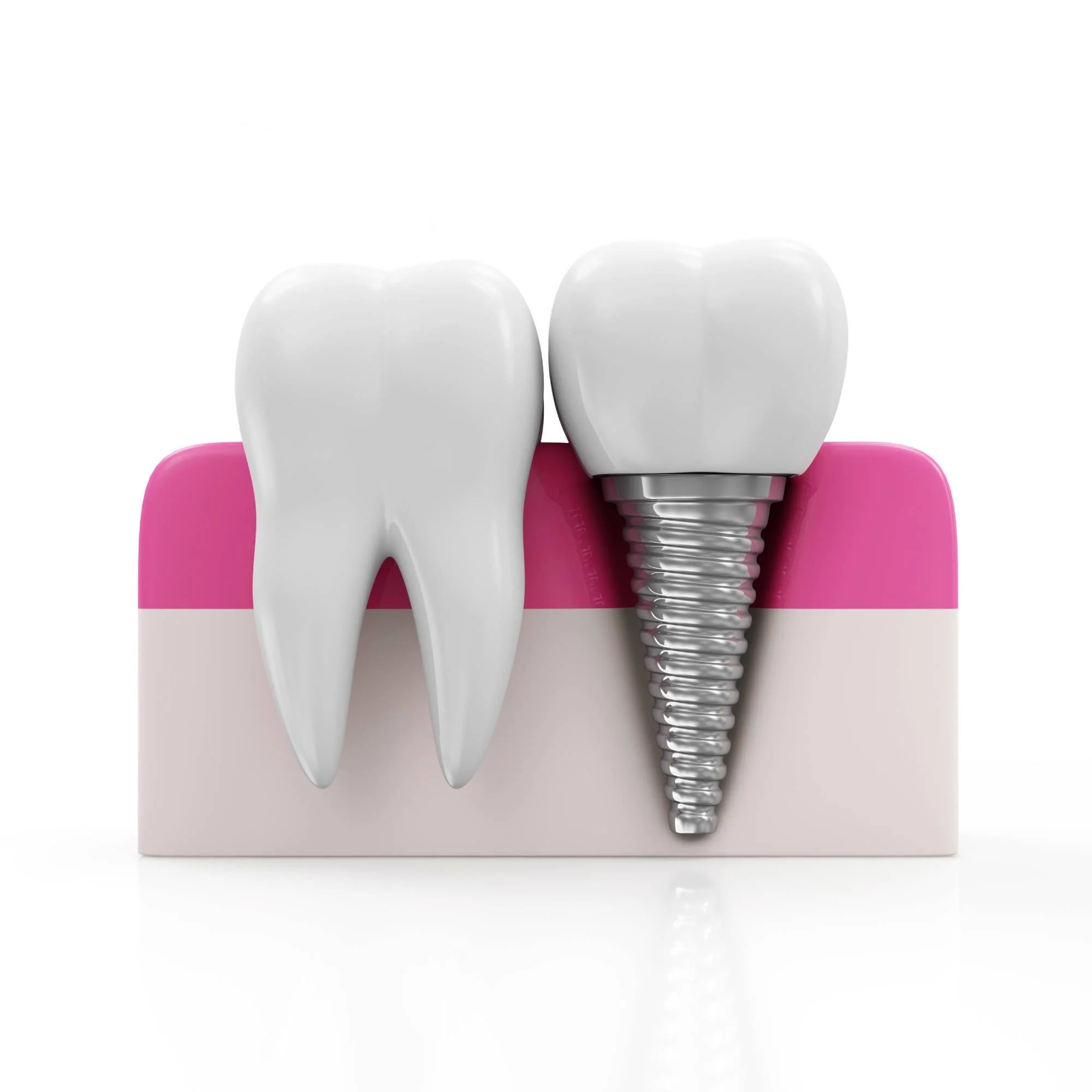 health tooth dental implant white at smile clinic salzburg