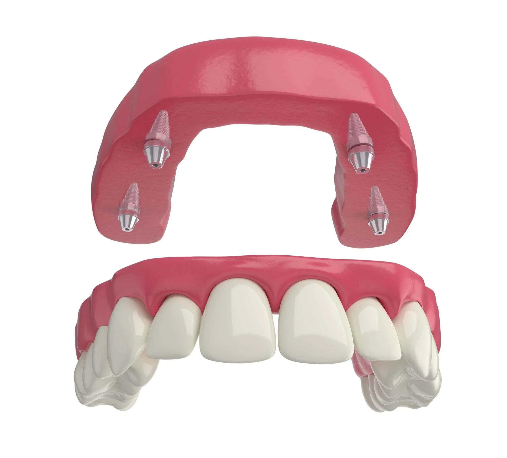 dental prosthesis 4 overdenture implants upper arch 3d render all-on-4 at smile clinic salzburg