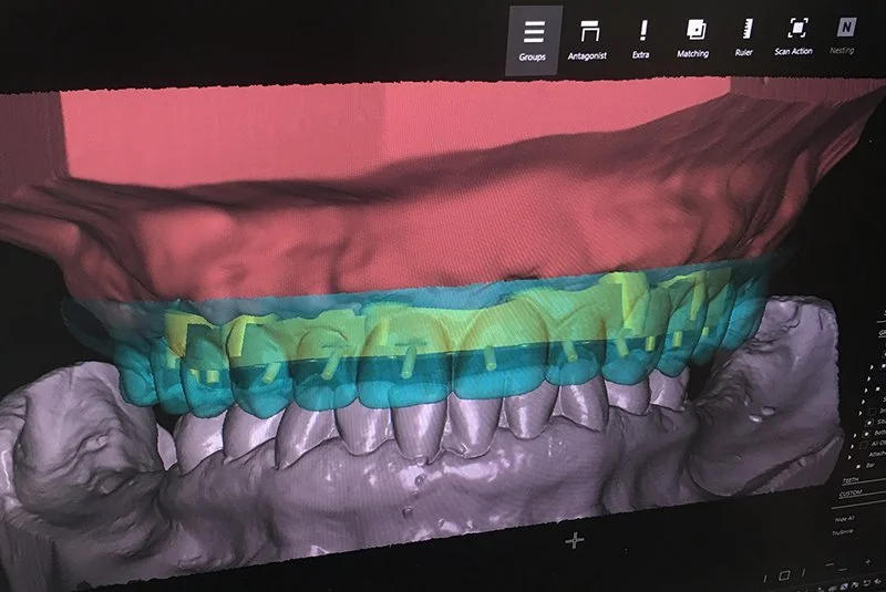 3D-Digitalmodell eines menschlichen Gebisses mit farblichen Markierungen und Zahnschienen, die auf den Zähnen sitzen.