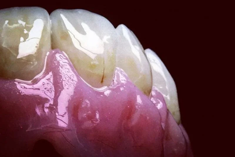 Nahaufnahme eines menschlichen Gebisses mit den oberen Zähnen, die auf einer pinkfarbenen Gaumenplatte sitzen, vor schwarzem Hintergrund.