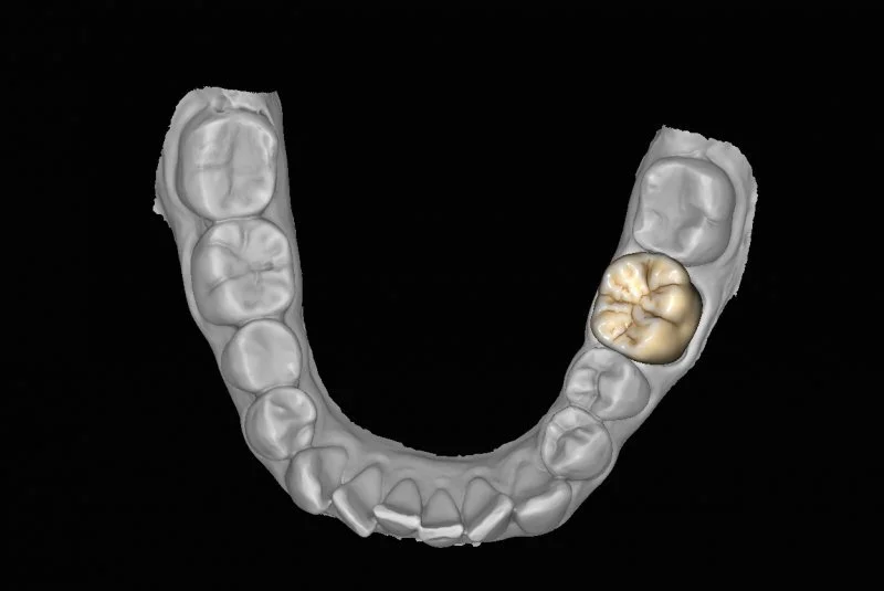 Digitales Abbild eines menschlichen Gebisses, mit einem Zahnarztkronen, die ein einzelner Backenzahn auf der rechten Seite ersetzt.