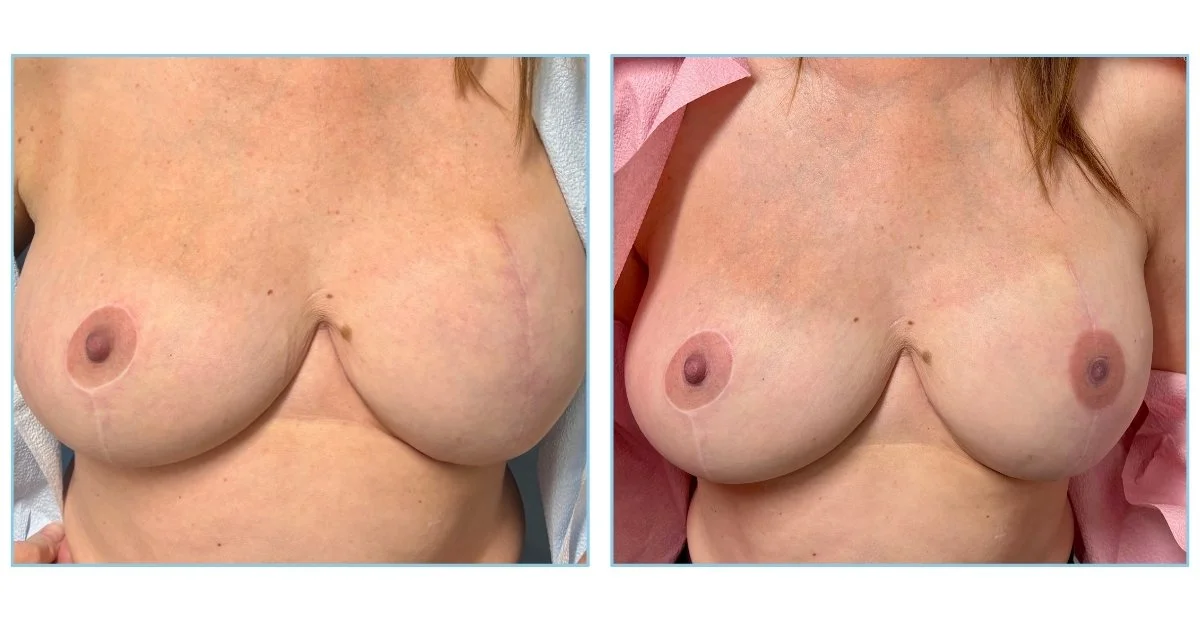 Unilateral Tattoo / Color Matching