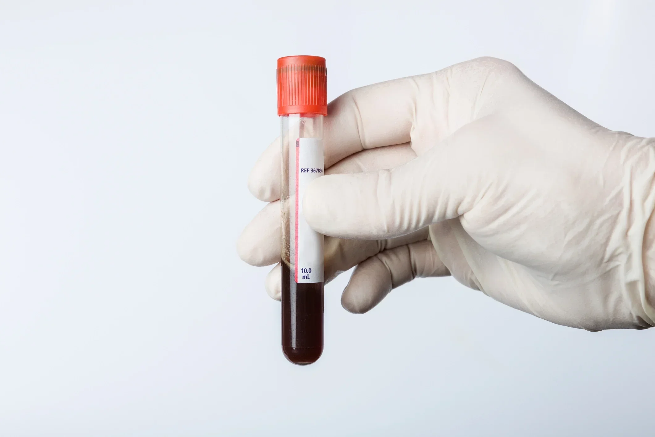 Gloved hand holding a blood sample tube, representing a biomarker blood test like CIZ1B to support earlier lung cancer detection.