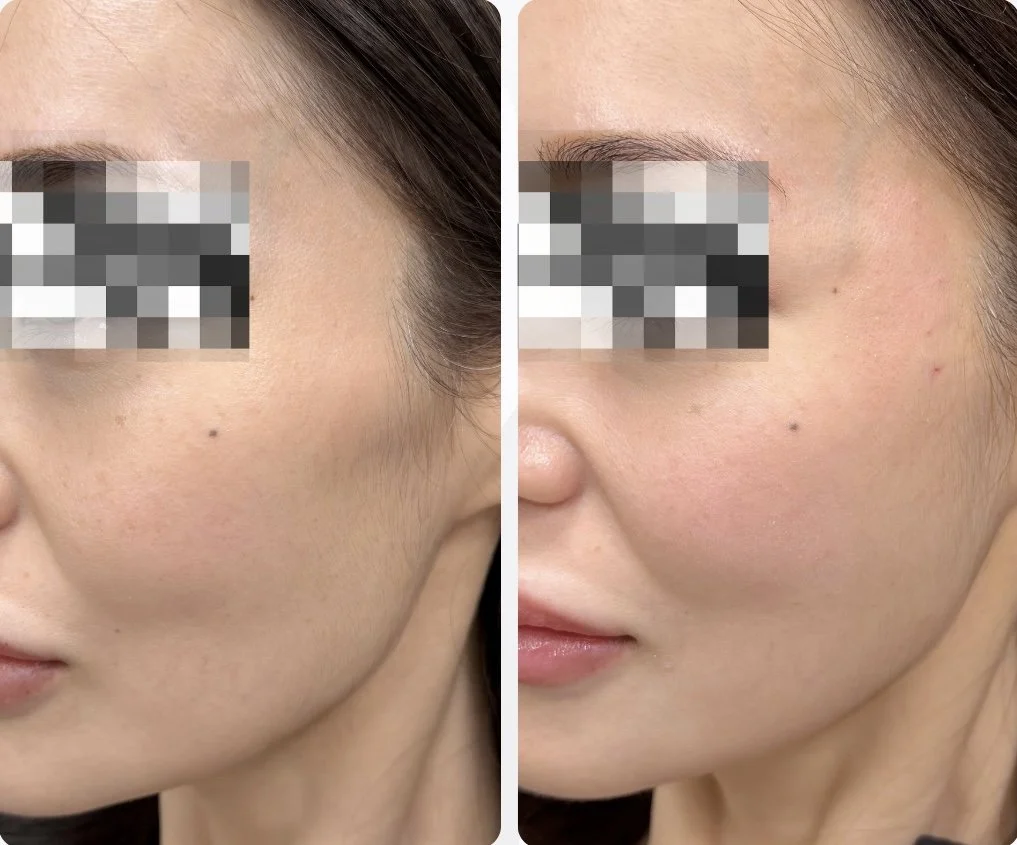 Cheek Filler