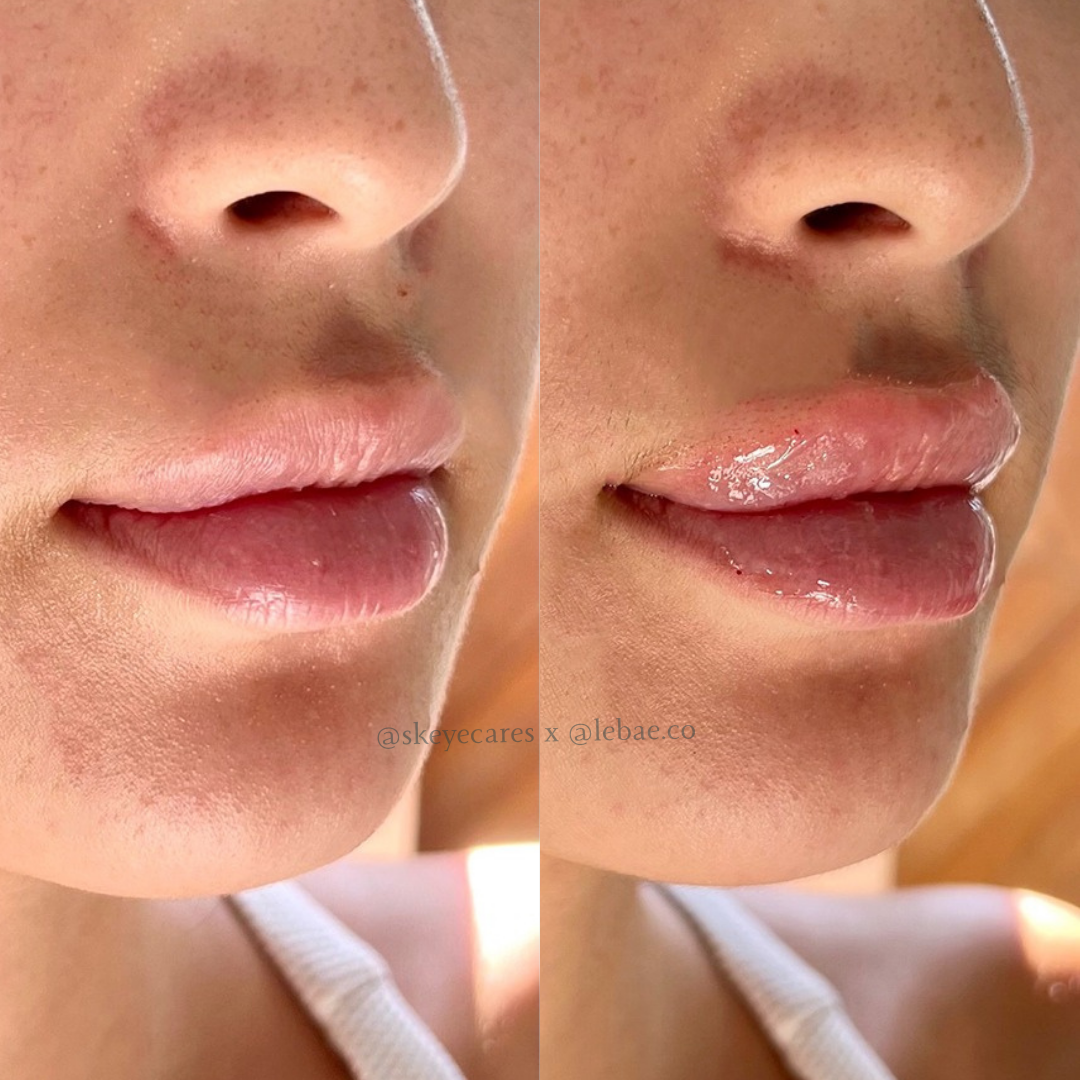 Close-up of a person's lips and nose area before and after applying lip gloss. The person has light skin with freckles, and is wearing a white strap top.