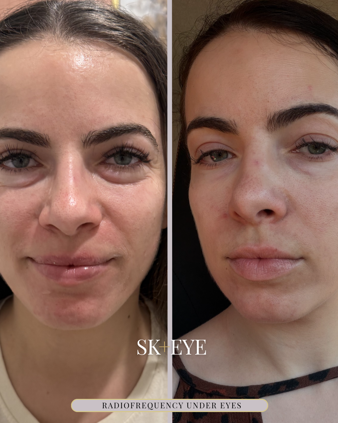Radiofrequency Under Eyes